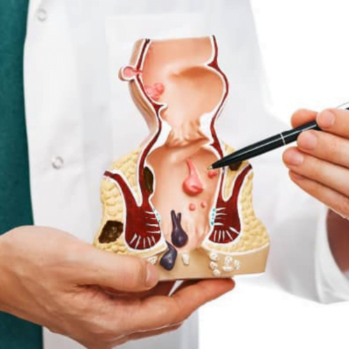 Anal Fissür (Çatlak)