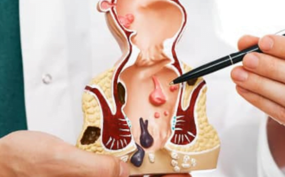 Anal Fissür (Çatlak)